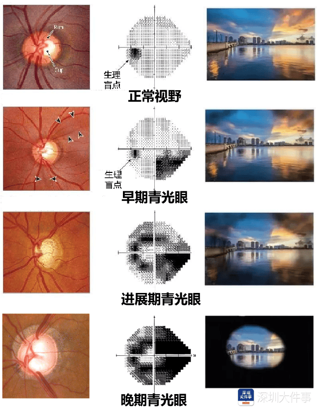 预防青光眼,这项户外运动每天10分钟,比眼药水管用