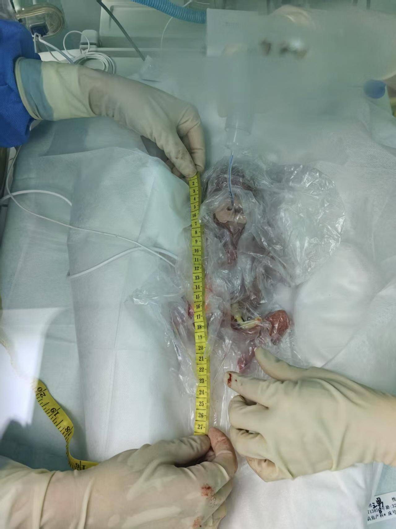 出生时体重仅380克一超早产儿98天后成功"闯关"出院