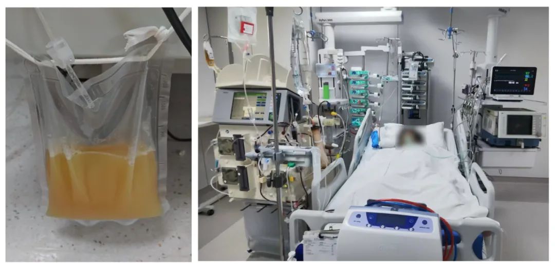 两名女子因高脂血症入院，专家用双重血浆置换将两人双双救治成功