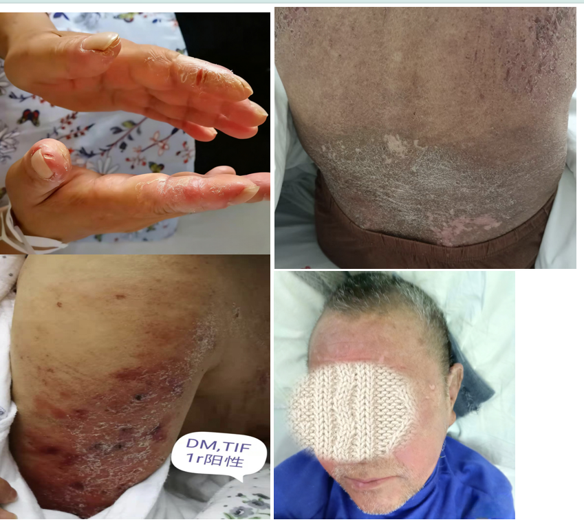 眼周发红、手变粗糙，别再乱涂药膏了！北大人民医院青岛医院风湿免疫科专家：可能是免疫系统在内讧