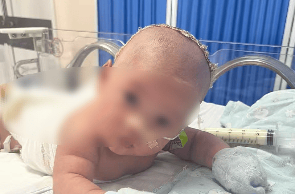 出生28天婴儿熏蒸致大面积烫伤，南方医院多学科协作成功医治