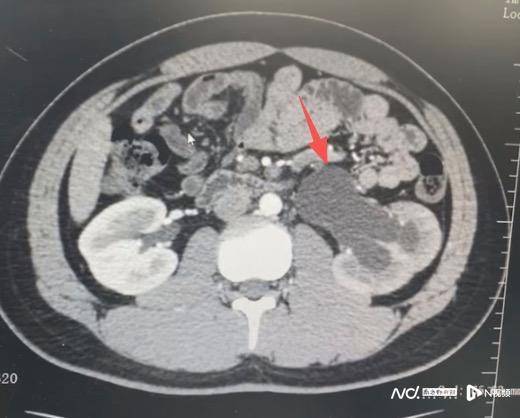 潜伏16年“撑坏”肾脏！少年剧烈腰痛后发现先天输尿管狭窄