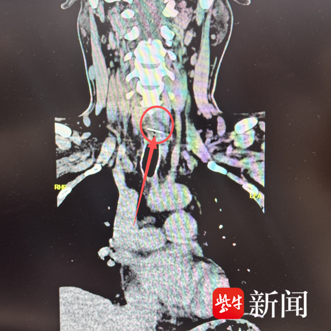 吃鱼头竟意外被“金属针”卡喉！鱼刺门诊轻松取出